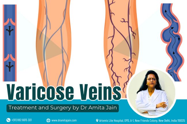 Dr Amita Jain is the best doctor for vericose veins